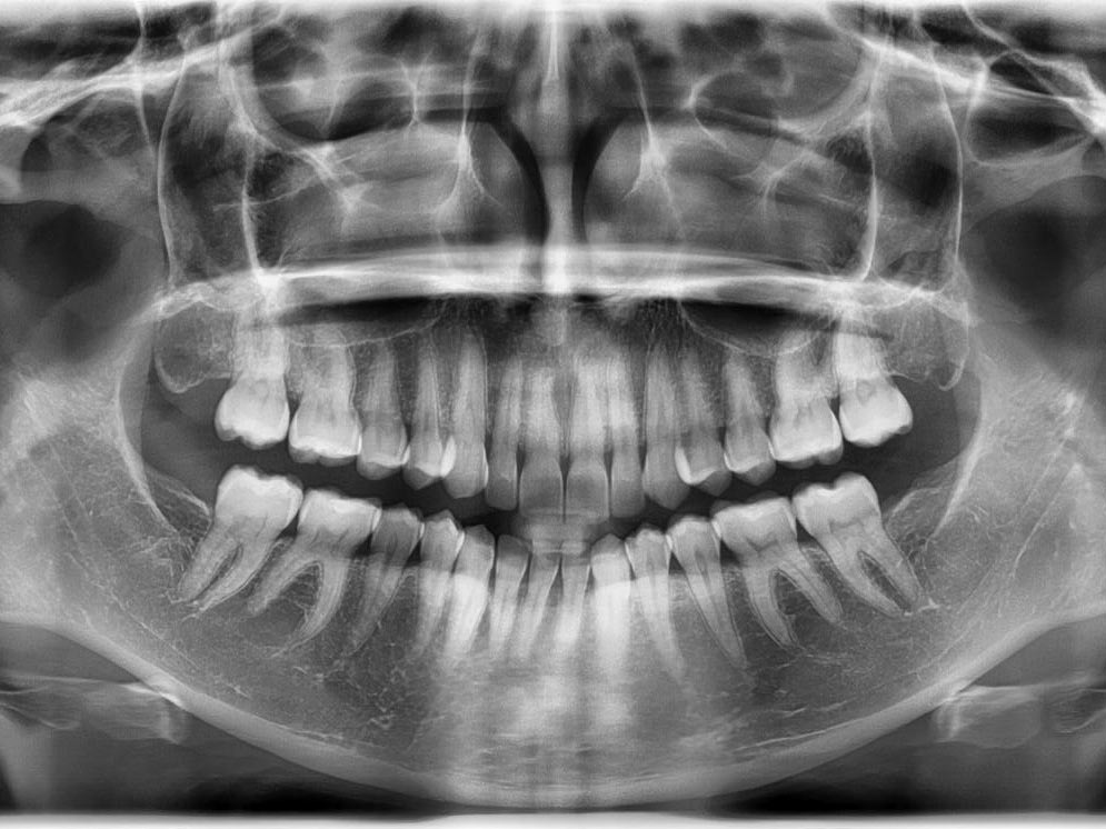 sisorad-RcefStudio-Pan---Para-ilustrar-a-radiografia-panorâmica-padrão